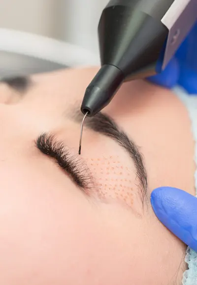 Blepharoplastie